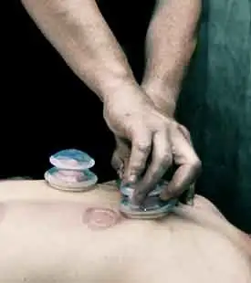 Cupping Massage Therapy in Chaparral, Calgary SE