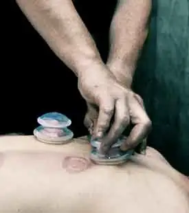 Cupping Massage Therapy